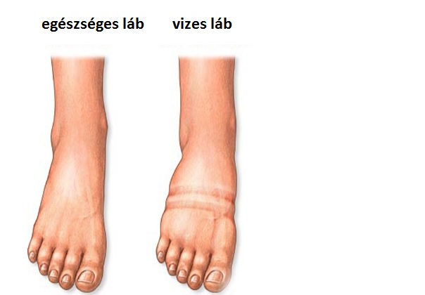 Vizesedsz, és hízol? Itt a megoldás! Az 5 legtutibb vízhajtó mód